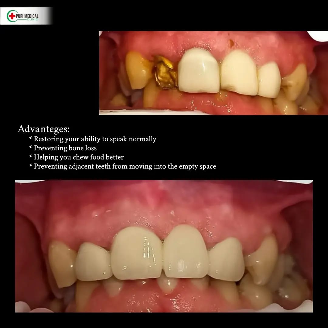 Dental bridge, after