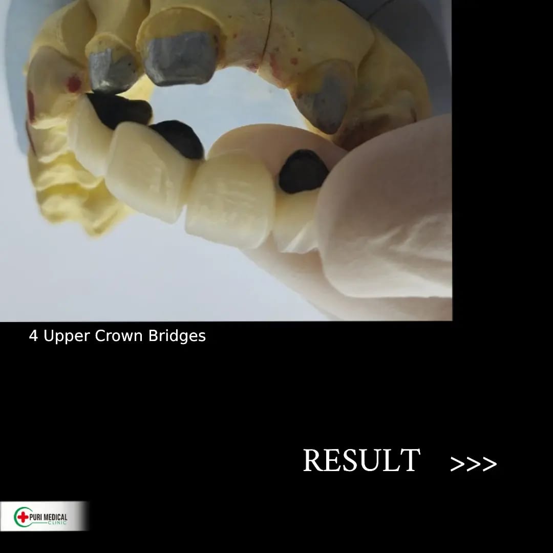 Upper crown bridge appliance