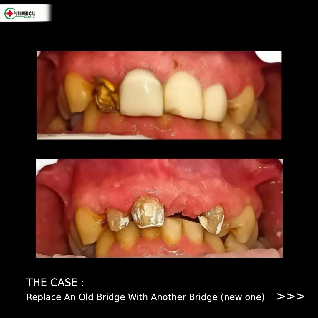 Dental bridge, before