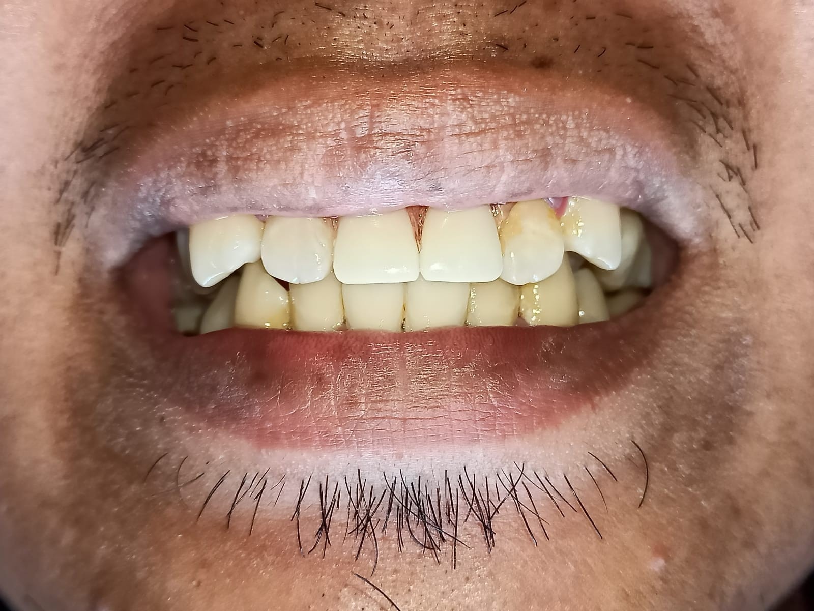 Dentures case, after treatment