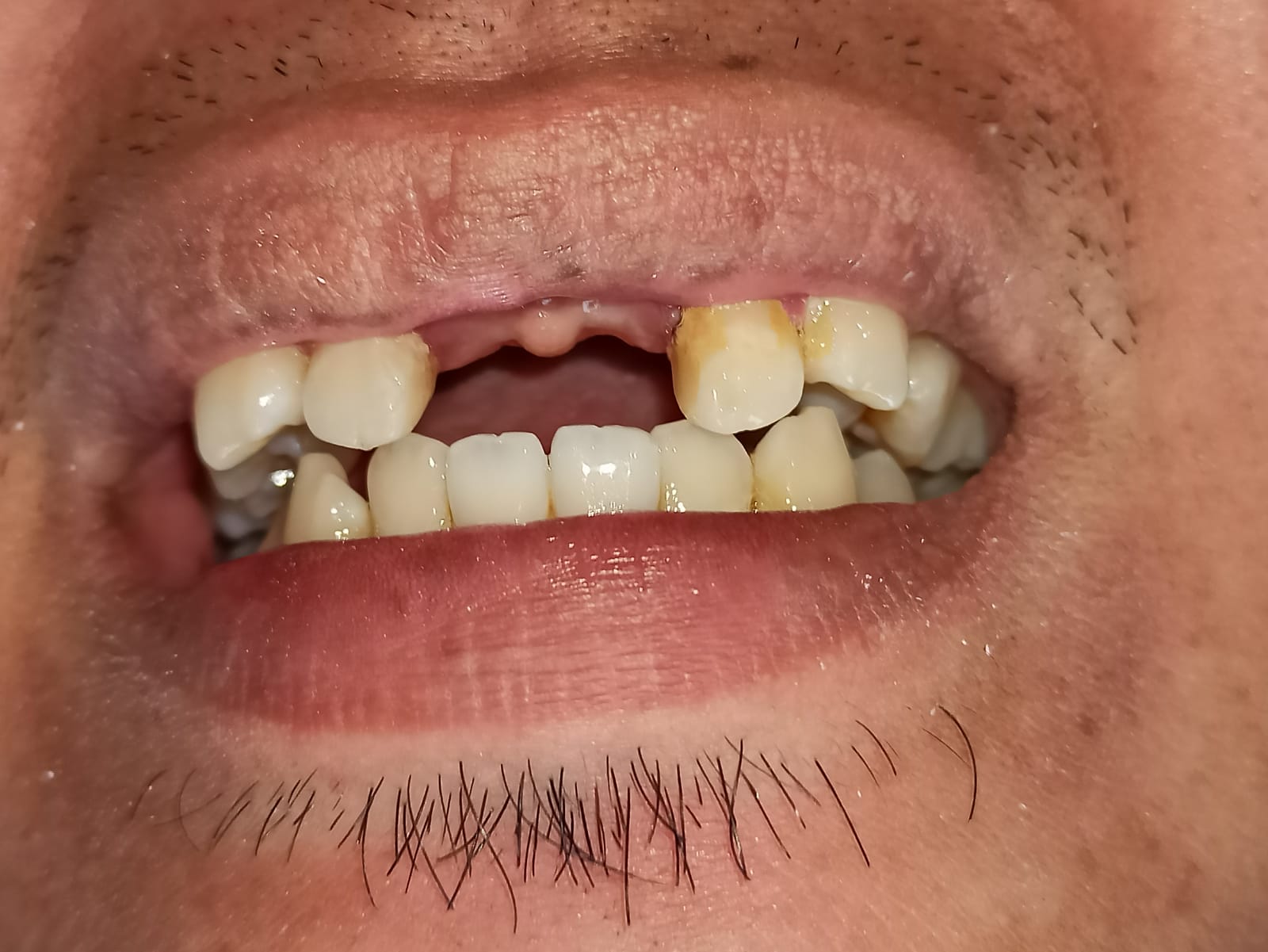 Dentures case, before treatment