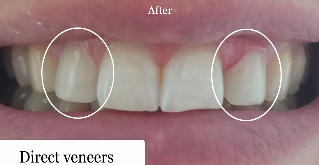 Direct veneer, after