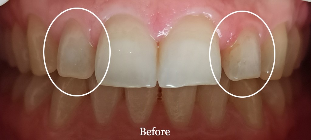 Direct veneer, before