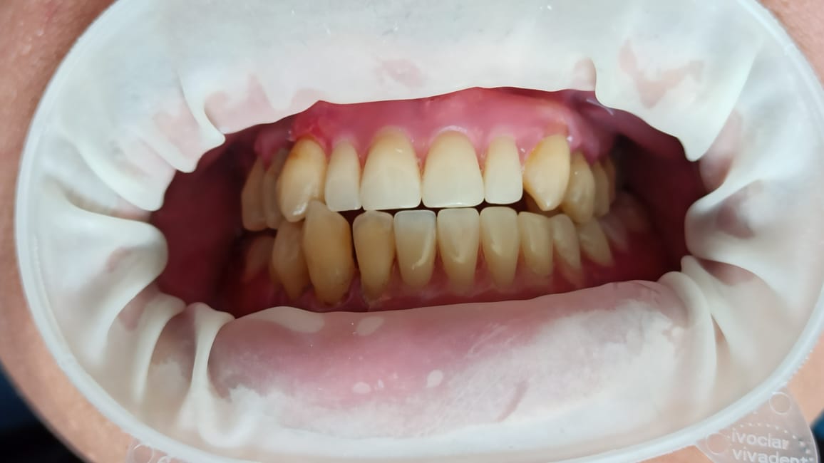Flexible partial denture, after