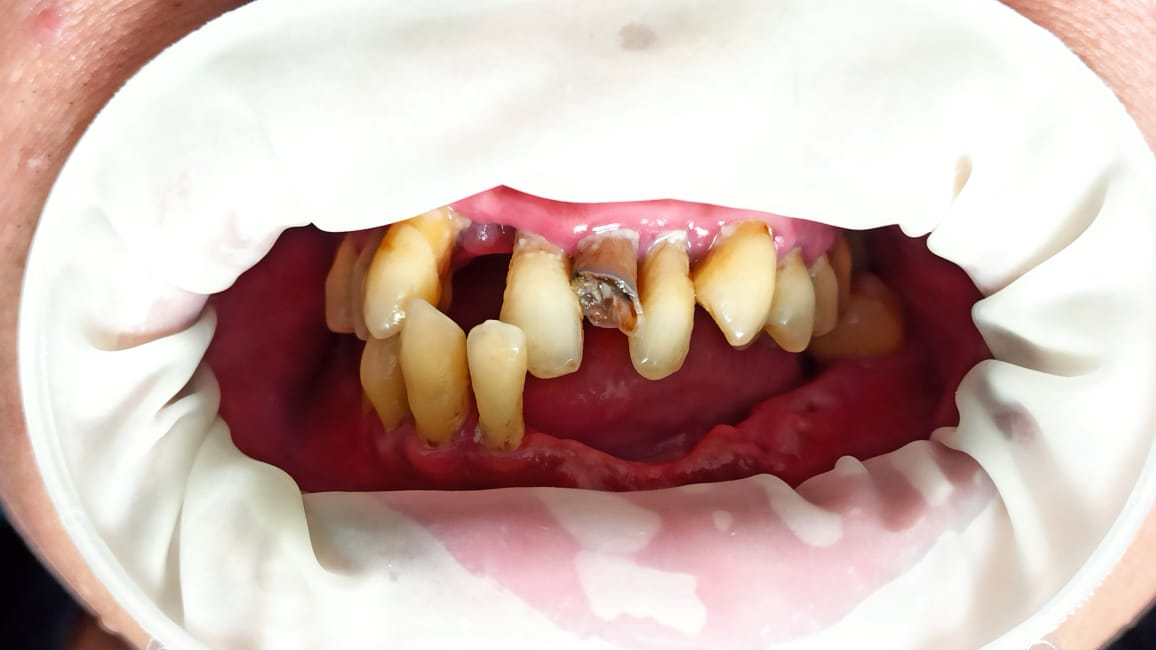 Flexible partial denture, before