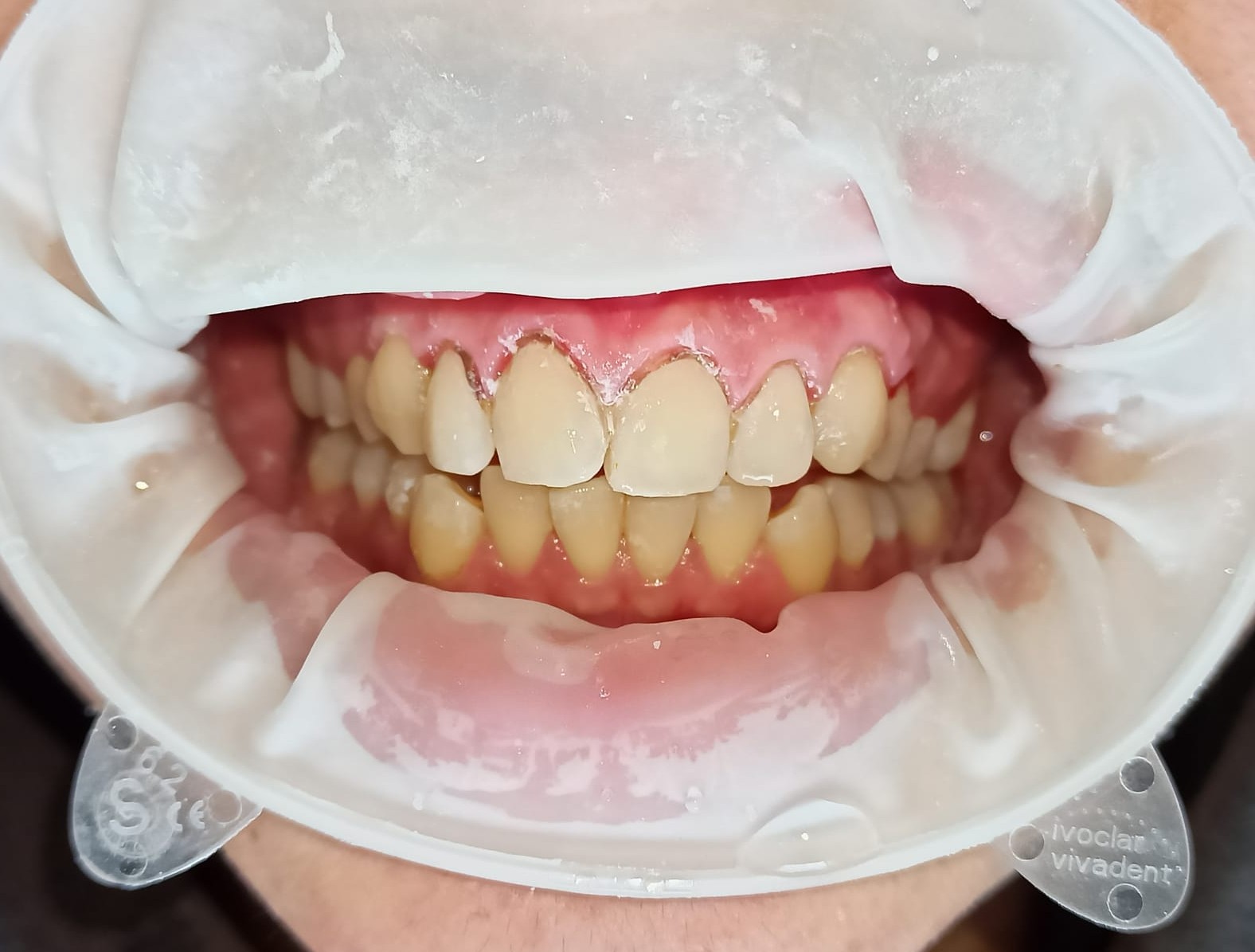 Remove veneers, after