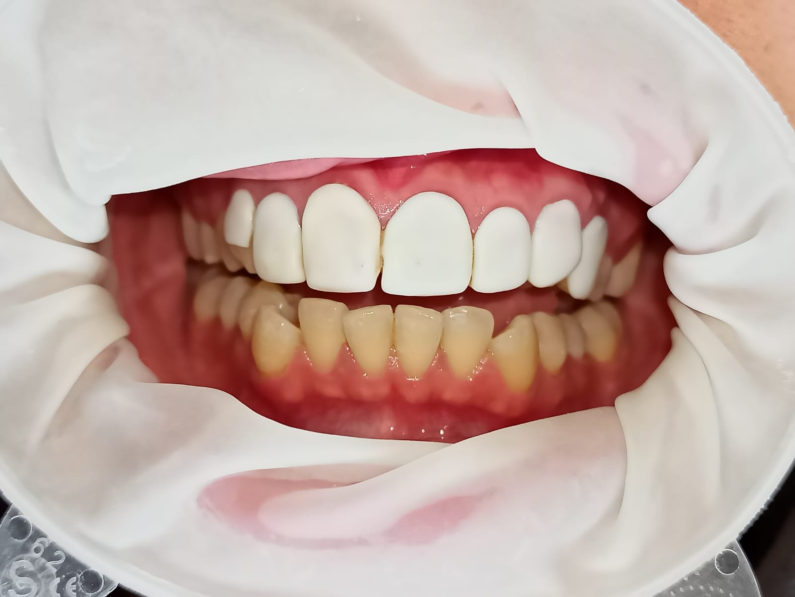 Remove veneers, before