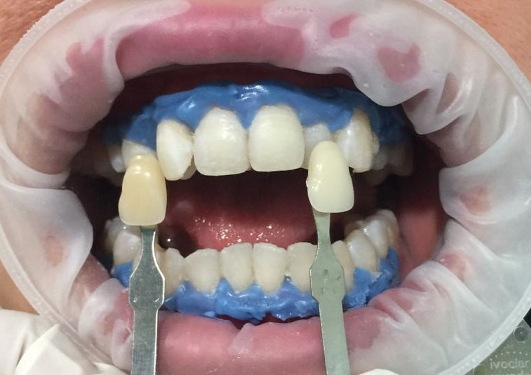 Teeth whitening, after