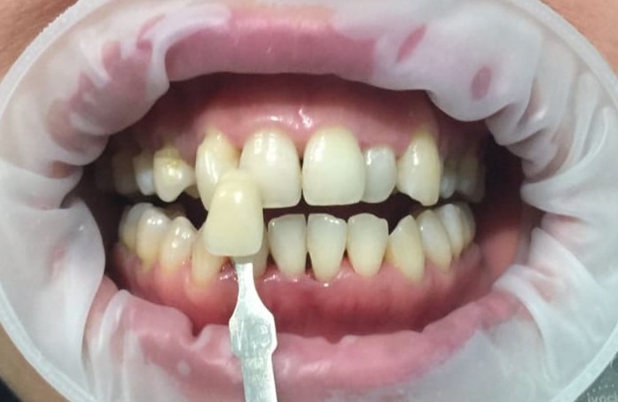 Teeth whitening, before